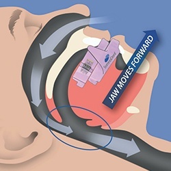 Animation of oral appliance movement